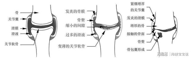 關(guān)節(jié)軟骨再生最新消息